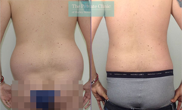 back-fat-male-liposuction-surgical-lipo-lipoplasty-before-after-results-photos