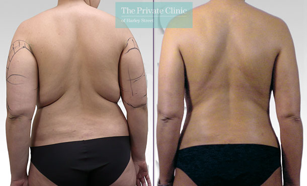 bra-bulge-back-fat-liposuction-surgery-lipo-lipoplasty-before-after-photos-results
