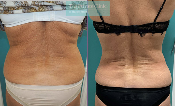 flanks-liposuction-fat-removal-micro-lipo-before-after-photos-results