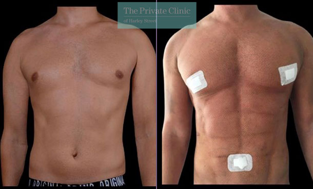 hi-def-vaser-liposuction-male-abs-chest-total-definer-surgeon-before-after-results