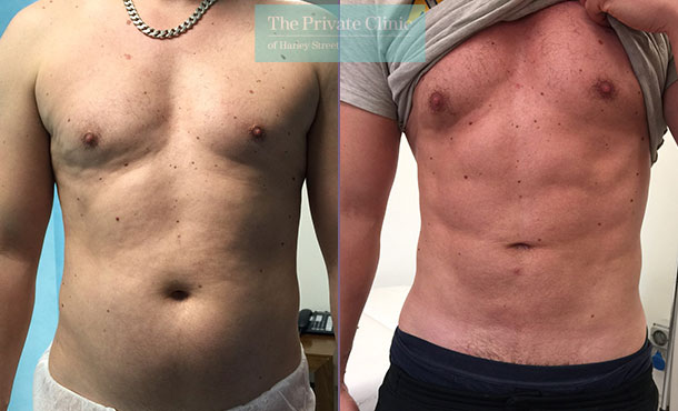 high-def-vaser-liposuction-lipo-male-before-after-results-photos-uk