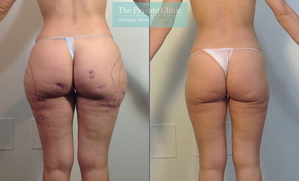 liposuction-hips-thighs-surgery-lipo-lipoplasty-uk-before-after-photos-results