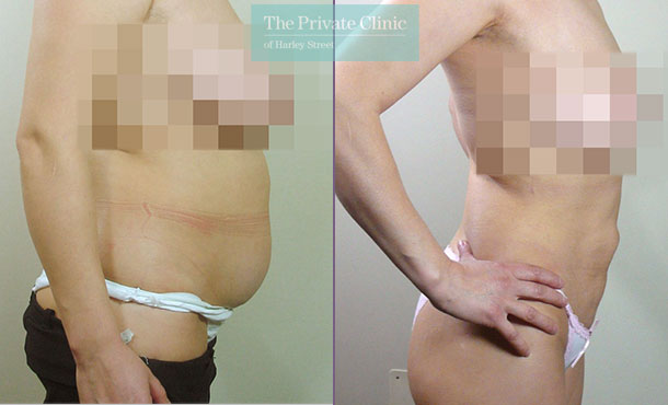 liposuction-stomach-abdomen-traditional-surgical-lipo-lipoplasty-before-after-photos-results