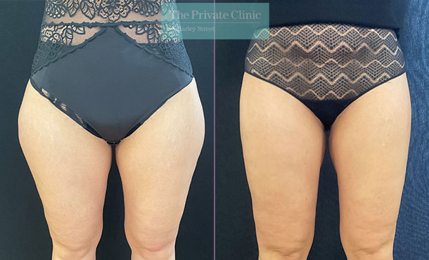 micro-lipo-thighs-liposuctions-fat-removal-legs-before-after-photos-results