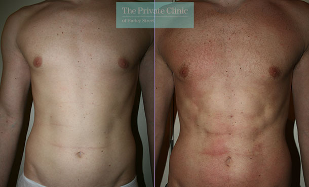 vaser-hi-def-lipo-male-abdomen-liposuction-before-after-photo-results