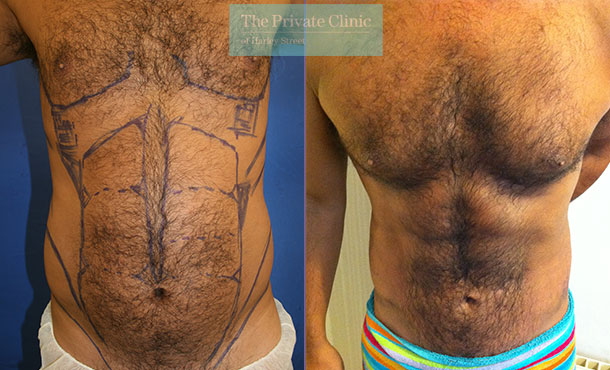 vaser-hi-def-liposuction-london-6pack-lipo-before-after-photos-results
