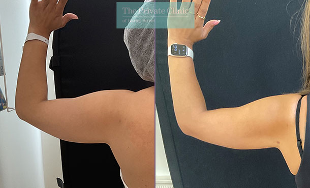 vaser-liposuction-arm-bingo-wings-left-before-after-results