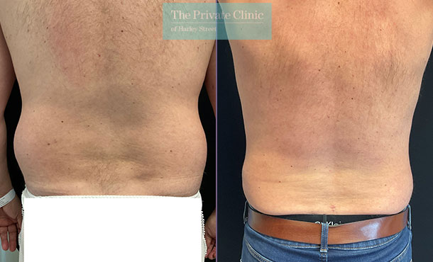 vaser-liposuction-lipo-male-flanks-before-after-results-photos