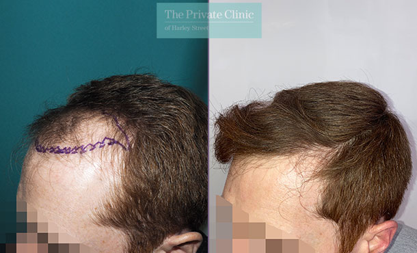 FUE Hair Transplant, temple restoration, before after photos 3741 hairs, 1559 grafts