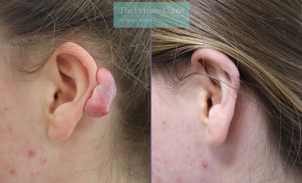 keloid-scar-removal-earlobe-correction-mr-mark-lloyd-before-after-results-014ML