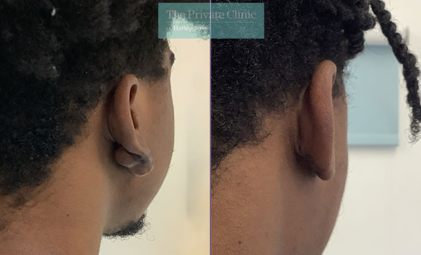 keloid-scar-removal-earlobe-correction-ms-helena-antoniadou-before-after-results-005HA