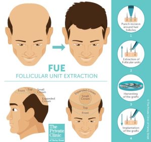 how to perform a follicular unit extraction FUE hair transplant