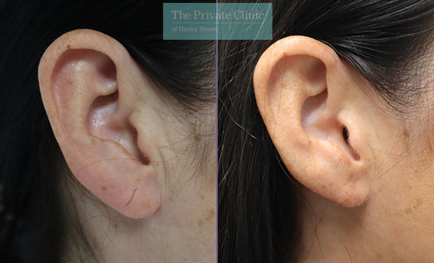 Split Earlobe - 032ML