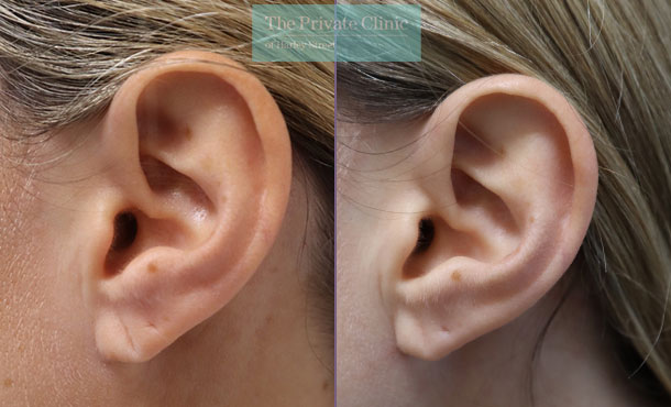 Split Earlobe - 034ML-left