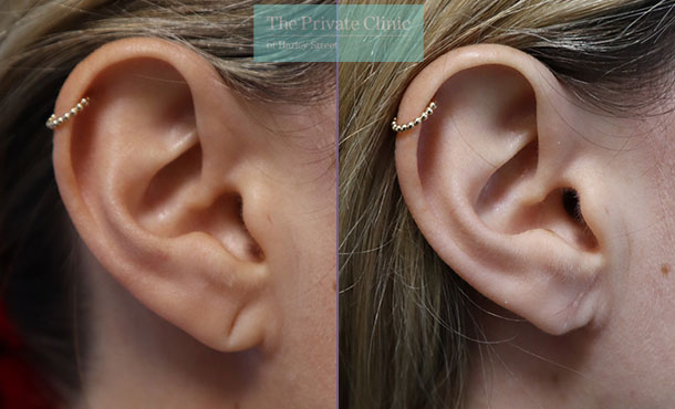 Split Earlobe - 034ML