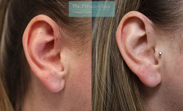 Split Earlobe - 044ML-right