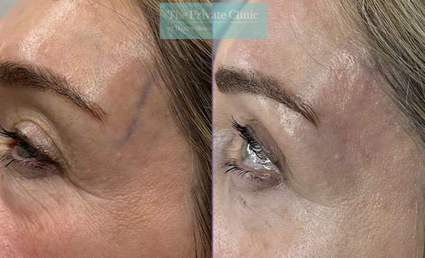 veins around eyes before and after photos result