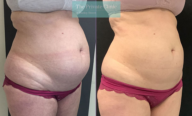 CoolSculpting 6 cycles abdomen tummy results  before and after photo