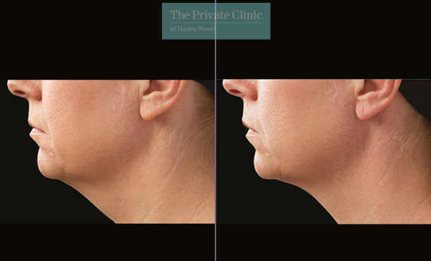 CoolSculpting results on chin after 2 cycles before and after photo