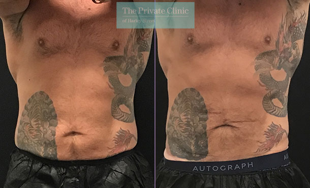 4 cycles fat freezing male abdomen tummy  before and after photo