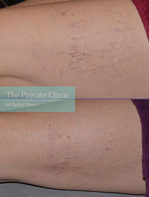 leg-thread-veins-removal-spider-veins-sclerotherapy-leeds-results