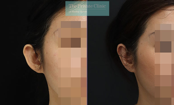 Otoplasty - 056ML-side