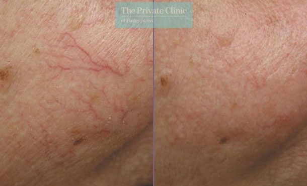 red-veins-on-face-removal-leeds-spider-thread-veins-treatment-results