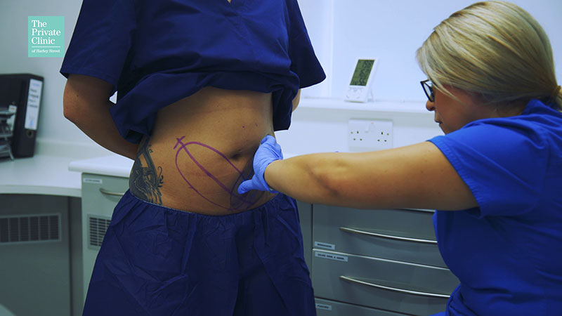 coolsculpting-fat-freezing-consultation-assesment-marking-treatment-plan