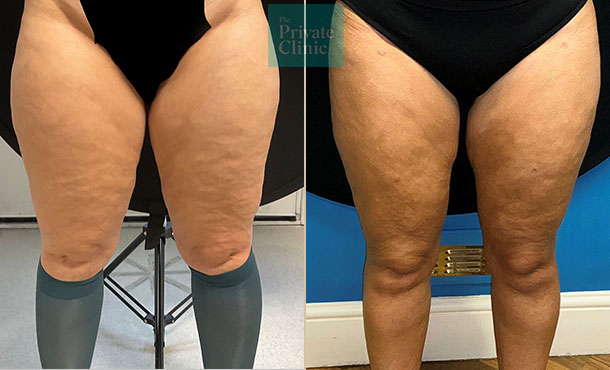 6 weeks upper legs lipoedema - vaser lipo treatment before and after results