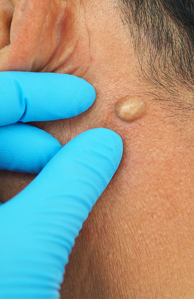 lumps and bumps removal