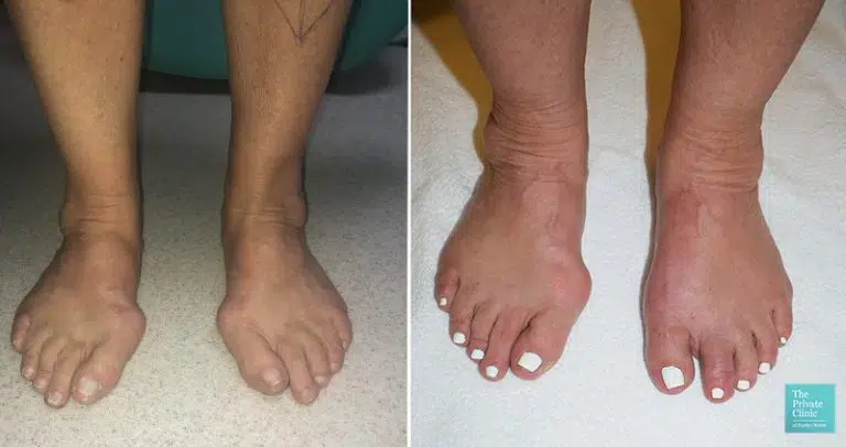Minimally Invasive Bunion Surgery