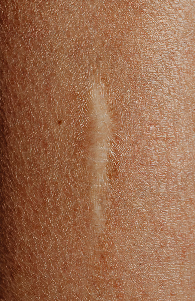 Faded scar on body