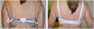 Bra Strap Lipo, Bra Strap Area Liposuction