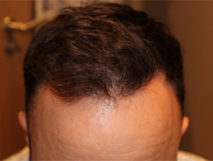 5 months after hair transplantation procedure