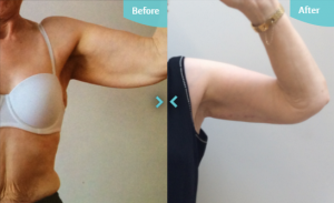 Arm Lift before and after results The Private Clinic