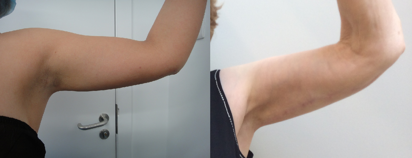 Arm lift and MicroLipo arm before after results