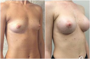  natural looking breast augmentation before after photo