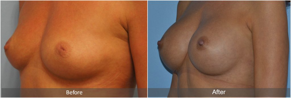 Before and after BBA & Inverted Nipple Correction with Mr Adrian Richards. 