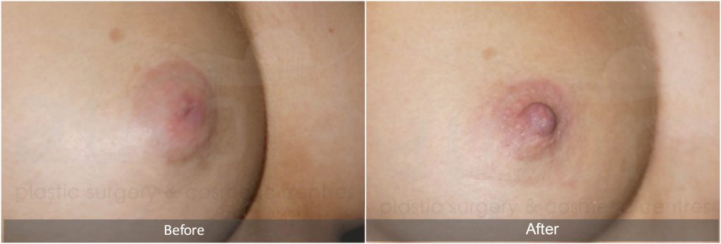 Before and after Inverted Nipple Correction with Mr Miles Berry. 