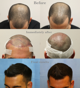 Before, During, After Hair Transplantation The private clinic results FUE 2