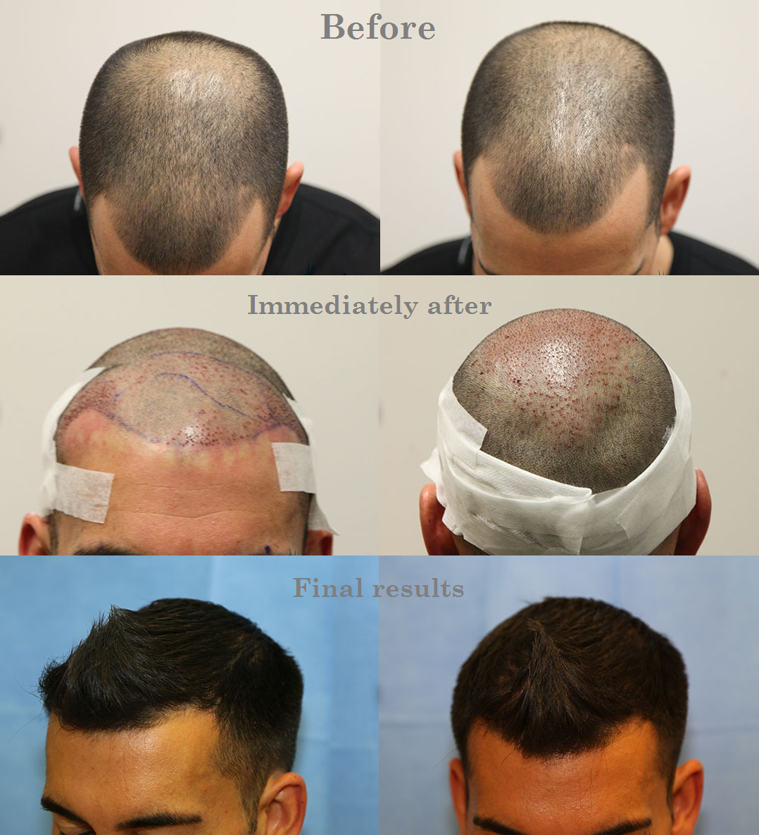 Hair Growth After Hair Transplant | After Follicular Transfer Fue Hair Transplant