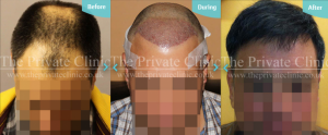 Before, immediately after and final hair transplant results by The Private Clinic'