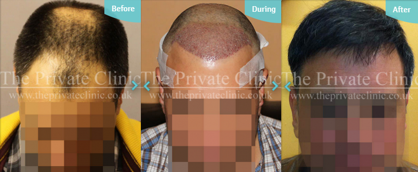 Hair Growth After Hair Transplant After Follicular Transfer Fue Hair Transplant