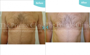 MicroLipo Male Chest Treatment before after photo