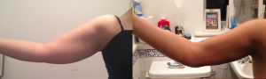 Before and After MicroLipo Arms