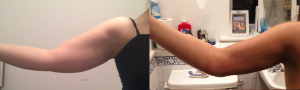 liposuction arm fat removal before after photo