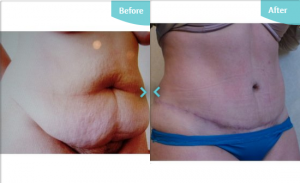 Before and After Tummy Tuck at The Private Clinic