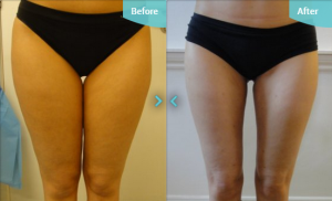 Before and after MicroLipo to the thighs