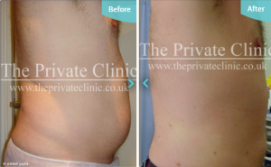 MicroLipo treatment to abdomen Before and after photo the private clinic
