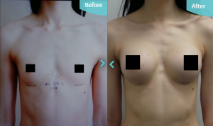 Breast Augmentation results